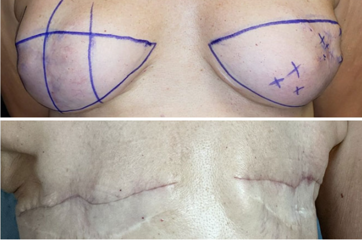 Breast lift surgery planning stages: pre-operative markings above, surgical incision lines marked below