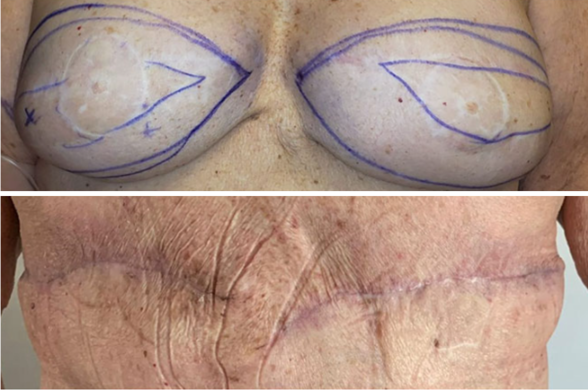 Breasts marked with surgical lines for flat closure technique, with post-operative result showing minimal scarring