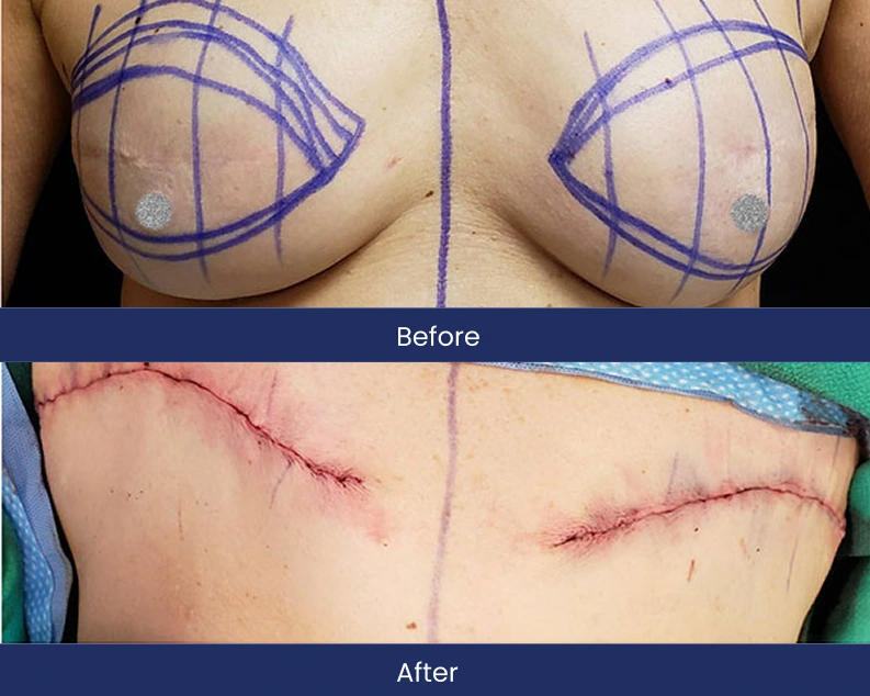 Before and after breast surgery: top shows surgical markings, bottom shows healed surgical incisions