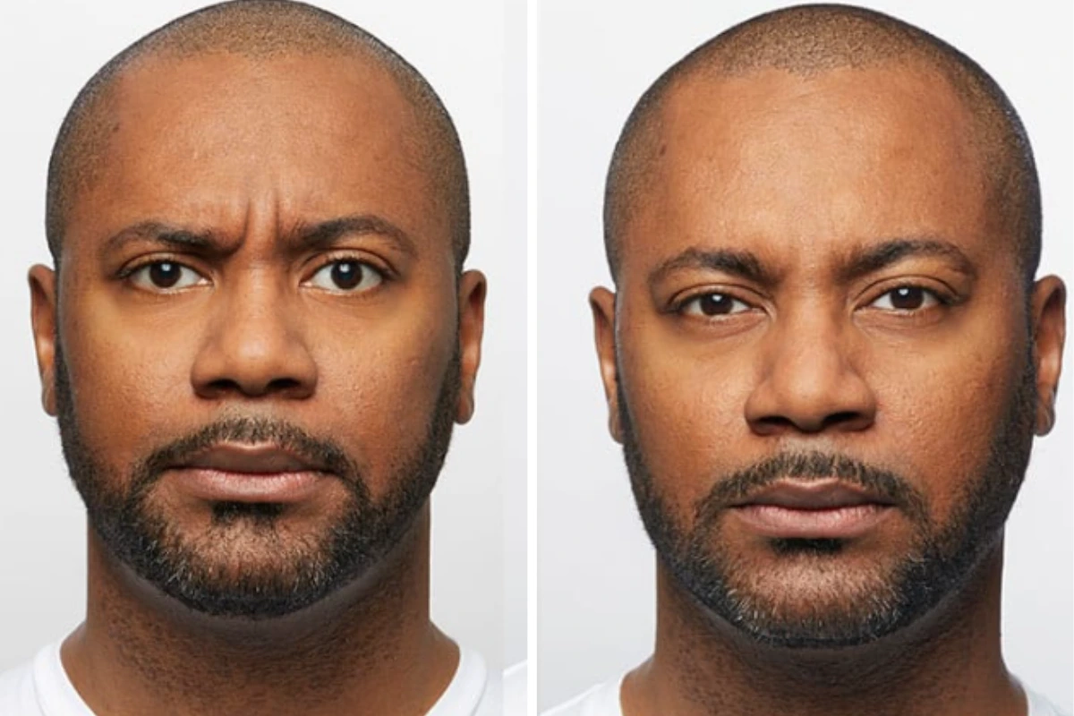 Before and after front view of man's face showing smoothed forehead and brow furrows