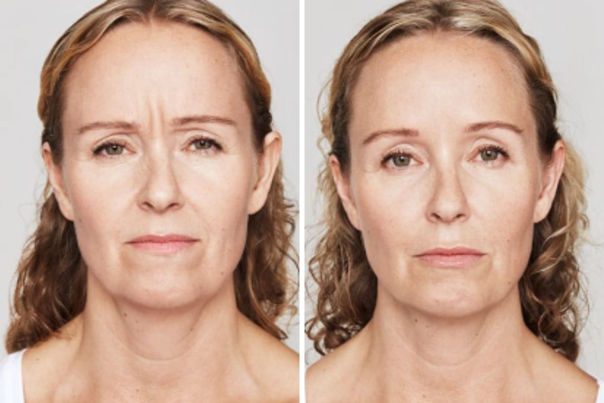 Before and after front view of woman's face showing reduced forehead wrinkles and glabellar lines