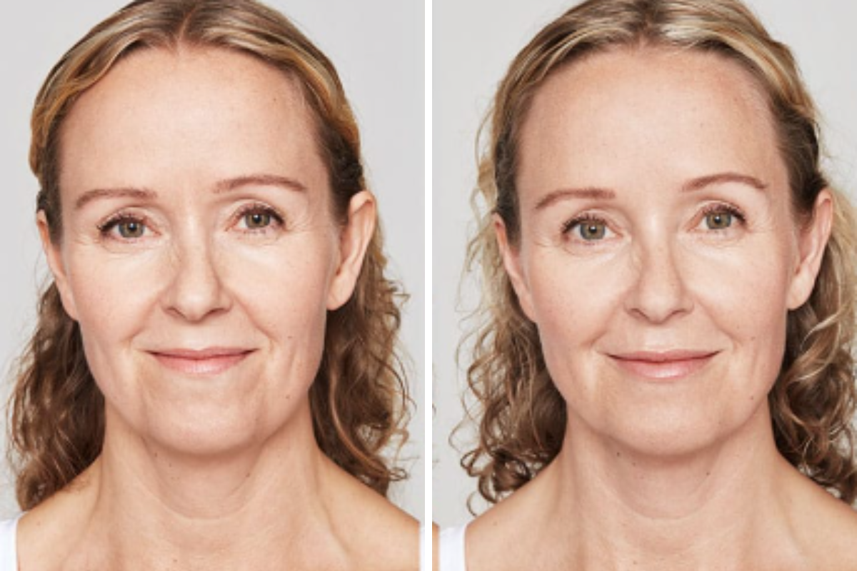 Before and after front view of woman's face showing softened facial expression lines