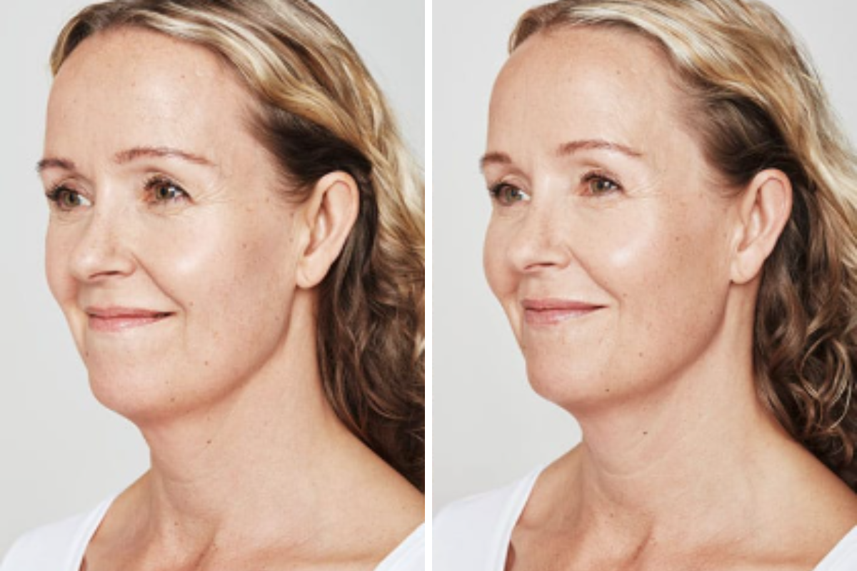Before and after profile view of woman's face showing softened forehead and glabellar lines