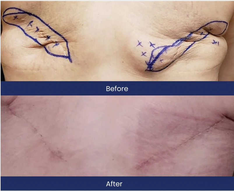 Before and after breast flap reconstruction with surgical markings and healed result