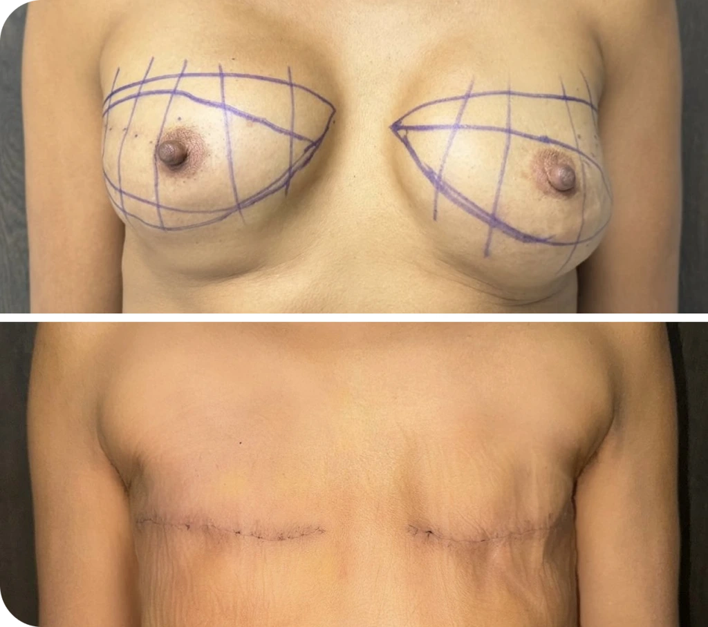Breast marked with surgical planning lines for implant removal with flat closure