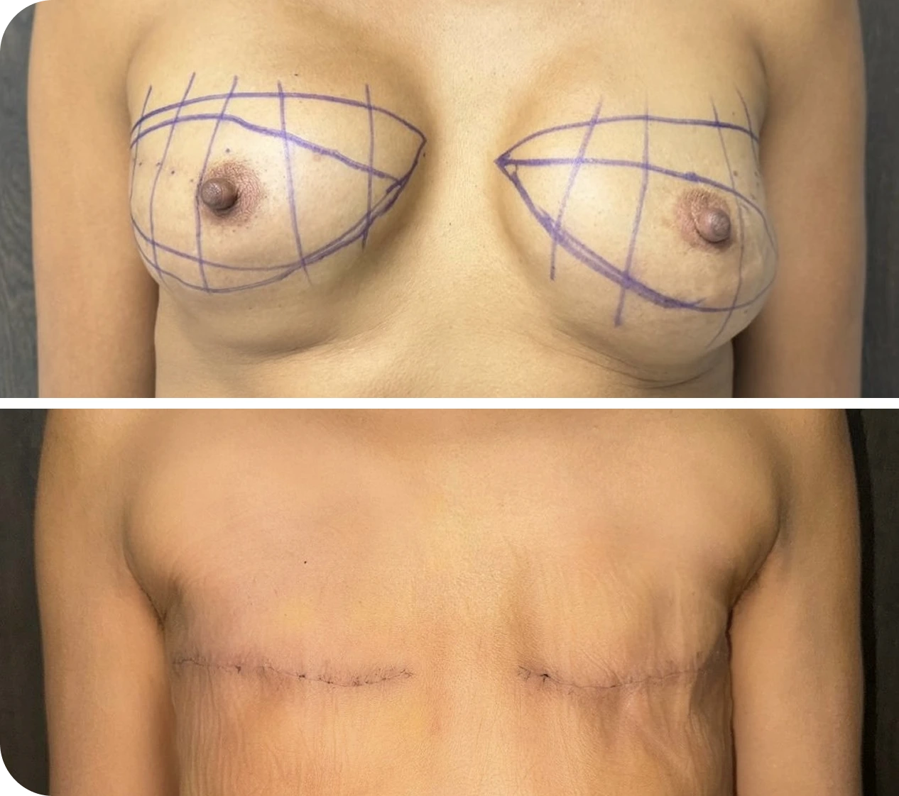 Breast marked with surgical planning lines for implant removal with flat closure